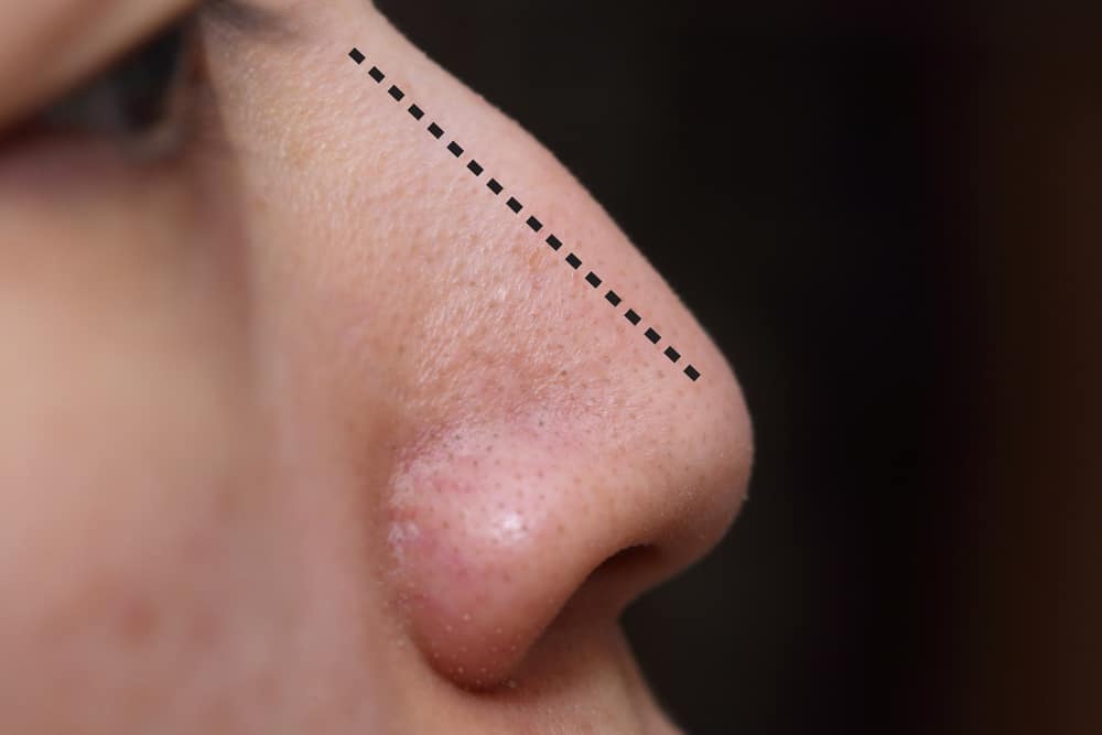 μύτη piercing χειρουργική επέμβαση