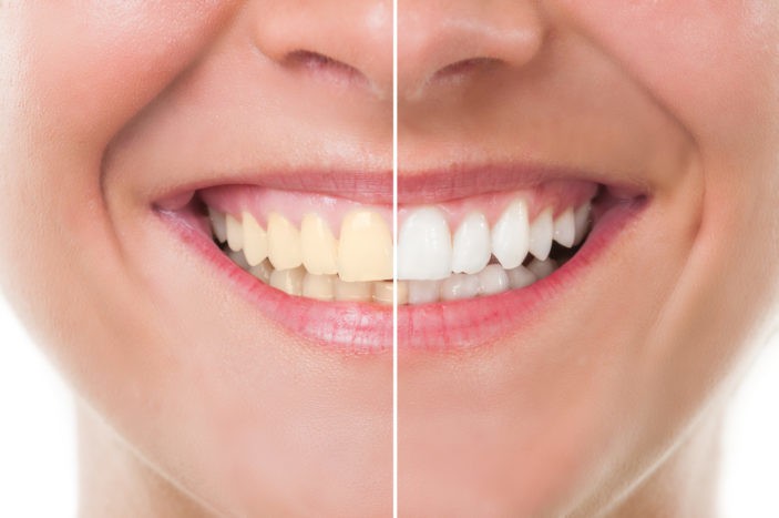 Παρενέργειες των λευκαντικών δοντιών με λεύκανση