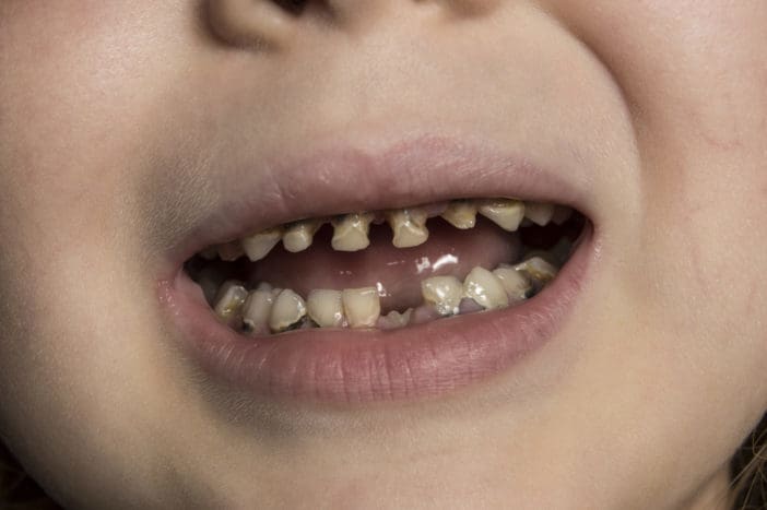 φθορά των δοντιών μπουκαλιών μωρών για τη φθορά των δοντιών των παιδιών