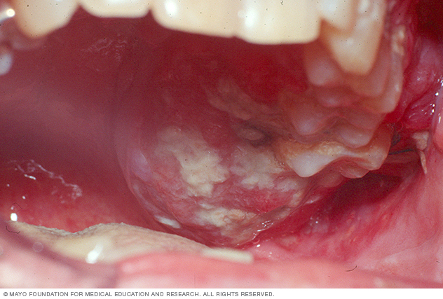 καρκίνο του στόματος