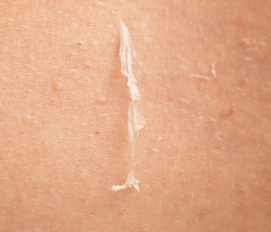 αιτίες της υπέρβασης του ξεφλουδισμένου δέρματος